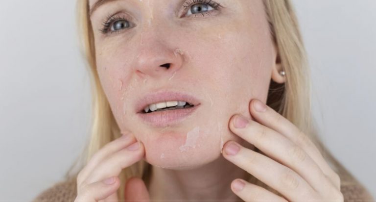 causes of eczema - dry skin